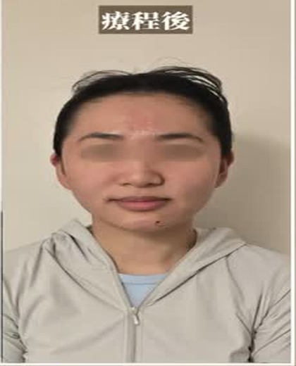 無創徒手小顏術 即時小顏效果個案 一次療程後（眼部已遮蔽保護私隱）