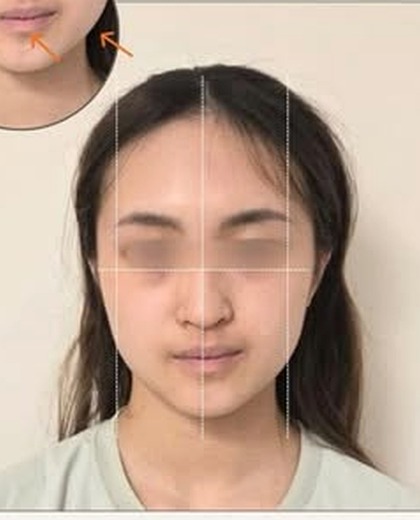 無創徒手小顏術 水腫感整理個案 療程前（眼部已遮蔽保護私隱）