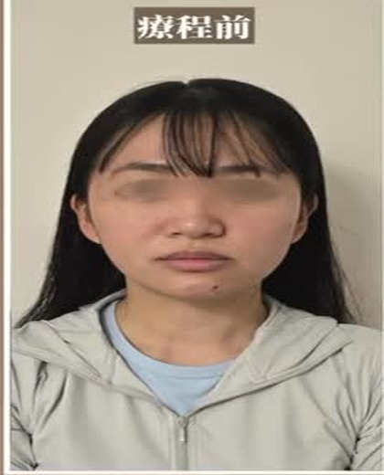 無創徒手小顏術 即時小顏效果個案 療程前（眼部已遮蔽保護私隱）