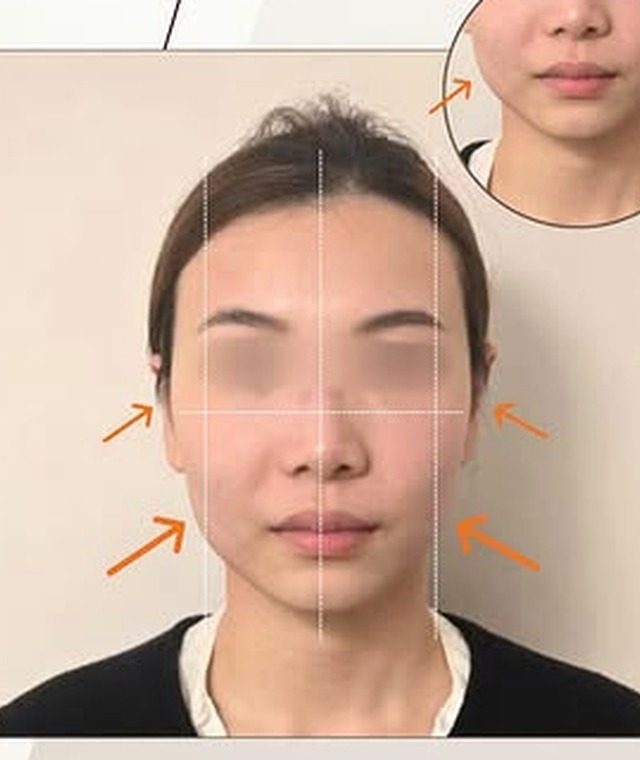 無創徒手小顏術後 面型比例與輪廓線參考示意